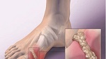 Ai bị bệnh Gút, đau rút cả xương - không hiểu tinh thể urat thì còn đau Gút tái phát