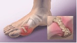 Ai bị bệnh Gút, đau rút cả xương - không hiểu tinh thể urat thì còn đau Gút tái phát